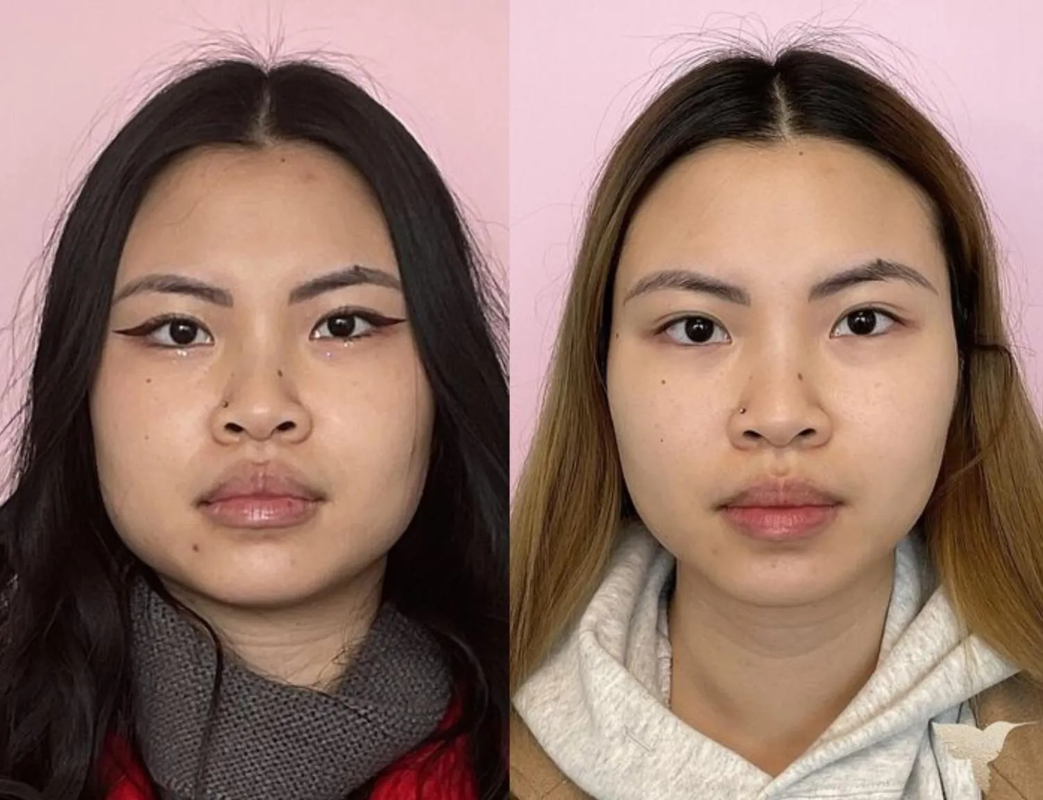 Jaw Botox